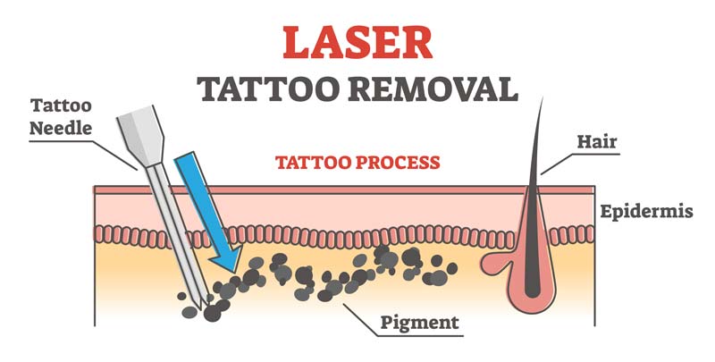 Laser-Tattooentfernung