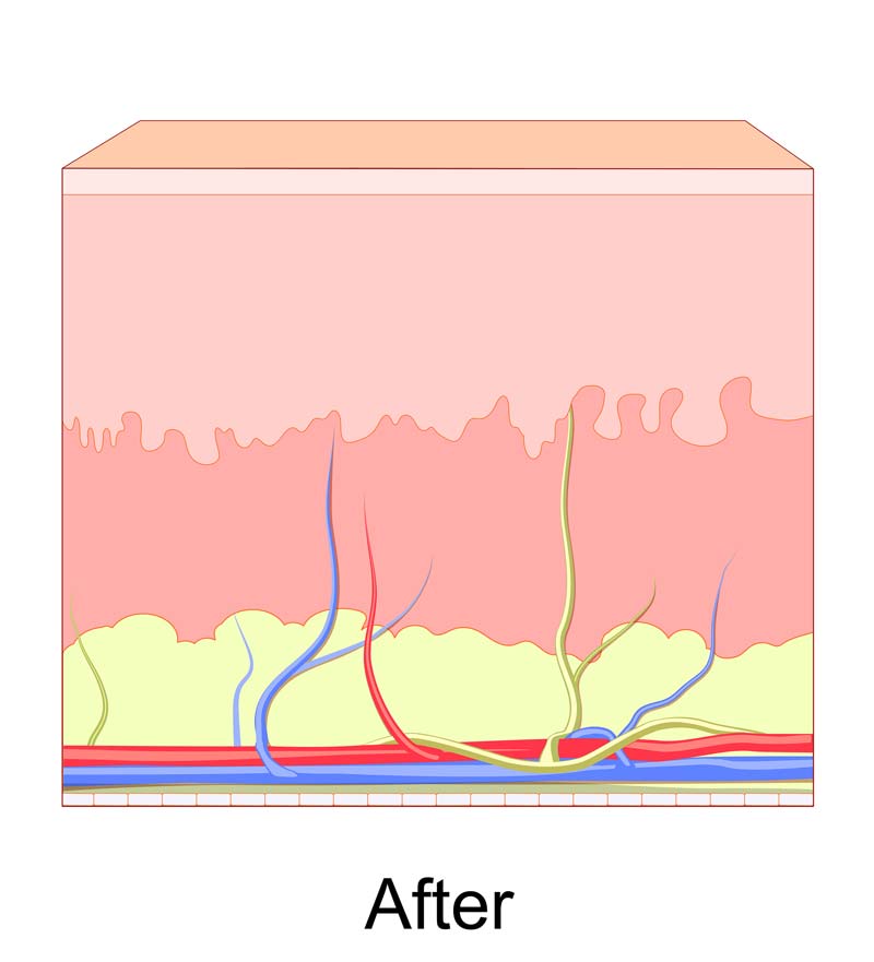 Medical MicroNeedling after