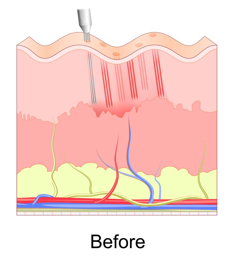 Medical MicroNeedling before