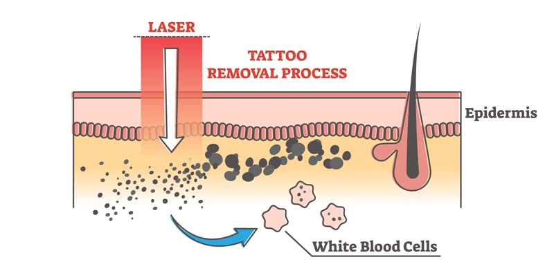 Professionelle-Tattooentfernung Professionelle Tattooentfernung
