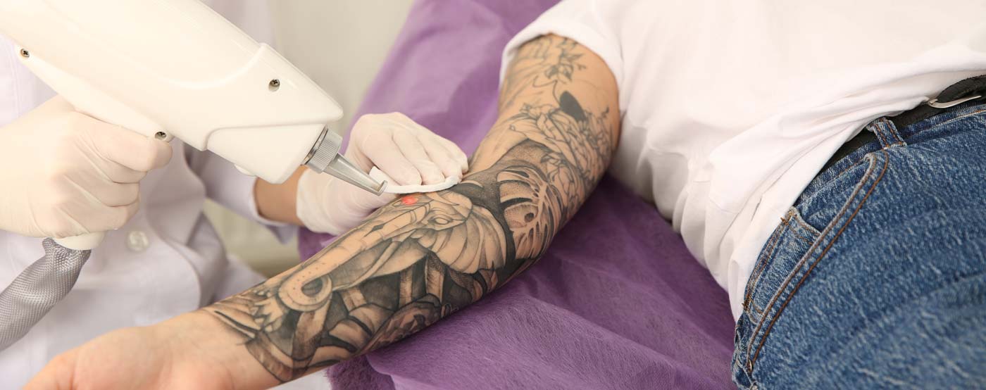 Tattoo Entfernung mit Pico Laser in Zürich Tattoo Entfernung mit Pico Laser in Zürich