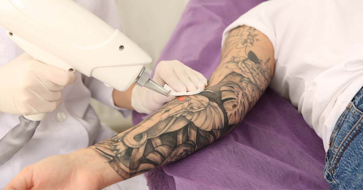 Tattooentfernung und Permanent Make-Up Entfernung in Zürich
